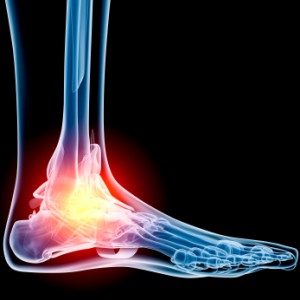Osteochondral Lesions of the Ankle: Evidence Based Diagnosis and Management