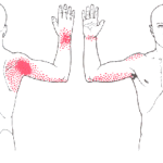 Identifying Subscapularis Tears: The Diagnostic Accuracy of Clinical Tests