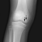 Juvenile Osteochondritis Dissecans Of the Knee: Assessment and Management