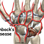 Kienbock’s Disease: Evidence Based Assessment and Management