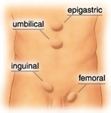 Potential Hernia Sites